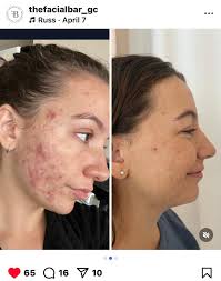 Seeking models with visible broken capillaries and sun damage