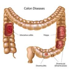 Image result for Diverticulitis