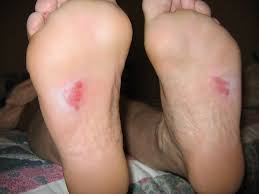 Athlete's foot is an itchy and red rash that usually affects the soles of the feet and between the toes. Footwear