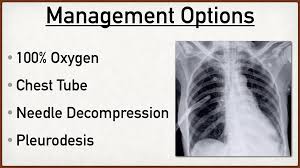 A pneumothorax can be caused by: Pt Trick For Pneumothorax Types Symptoms Risk Factors Causes And Treatment Of Collapsed Lung Ezmed