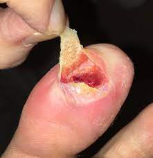 I picked da mutha fucka up n dropped him on da backa his. Plantar Wart Update Sooo This Just Happened My Blister From The Beetlejuice Popped I Peeled The Top Of The Wart Back And It Was Larger Than I Anticipated Popping