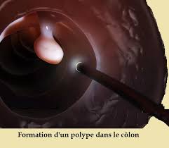 Ce test simple et non effractif permet de déceler des traces de the test can detect invisible (occult) amounts of blood in the stool. Causes Du Sang Visible Dans Les Selles Diarrhee Cancer Gastro Polype