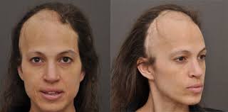 This study found that other treatments, including the use of. Cancer Patients Reconstructive Hair Transplant Update News Testimonial Mcgrath Medical