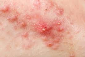 L'acne non è un problema tipicamente adolescenziale e si manifesta con caratteristiche differenti a seconda di età o sesso. La Dieta Anti Acne E Qualche Altro Segreto Per Dire Addio Ai Brufoli Alimentazione By Pazienti It