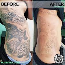 We will then pass the device over the skin as it emits the laser energy. How Many Sessions To Remove Tattoo Arxiusarquitectura