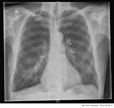 Maybe you would like to learn more about one of these? Malignant Pleural Mesothelioma Presenting With A Spontaneous Hydropneumothorax A Report Of 2 Cases Pulmonology