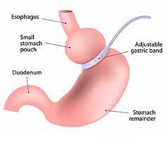 Hypno Gastric band