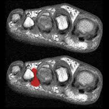 The neuroma is located between and is often located distal to the third and fourth metatarsal heads. Morton Neuroma Radiology Reference Article Radiopaedia Org