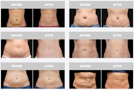 Coolsculpting Melbourne Chelsea Cosmetics 03 8822 3472 Cool Sculpting Coolsculpting Before And After Body Sculpting