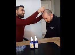 Mavi Su Sac Losyonu Yan Etkileri