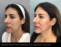 Before and After Photos of Fillers in Nashville