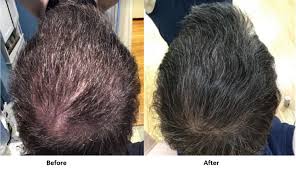 Stem cell therapy with prp has been used at the stem cell institute, in panama city. Exosome Therapy Alvi Armani Hair Transplant Los Angeles