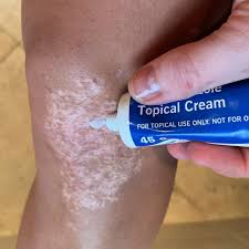 A cortisone cream, also called topical corticosteroid, has been prescribed by your physician to relieve your eczema or your child's eczema. Vitiligo Treatment How Topical Steroids Work Living Dappled