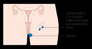 Image result for Vulvar Cancer