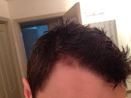 (cutting proscar into 5ths gives you propecia ). Switching From Propecia To Finasteride 5mg Am I Imagining Hair Loss Hairlosstalk Forums