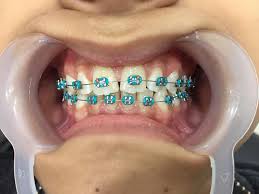 Ada yang pakai braces tak ? Klinik Pergigian Hidayah Posts Facebook