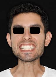 Myositis Ossificans Traumatica of Bilateral Medial and Lateral Pterygoid  Muscles: A Case Report