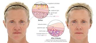 Faces Of South Tampa Lightstim Led Light Therapy South Tampa
