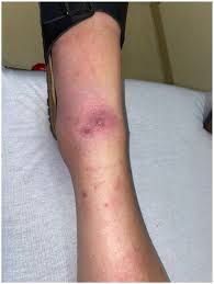 Image result for infected tick bite