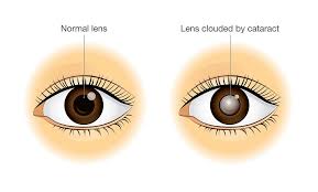 Check spelling or type a new query. Cataract Causes Symptoms Treatment And Surgery Kraff Eye Institute