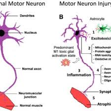 Not what you're looking for? Molecular Mechanisms In The Pathology Of Amyotrophic Lateral Sclerosis Download Scientific Diagram
