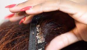 Remedies can range from washing your hair. 5 Natural Ways To Treat Dry Scalp Lifeberrys English Dailyhunt