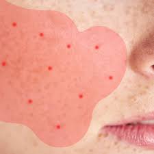 Image result for acne face
