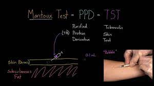 The world health organization (who) estimates that tb is 2nd only to hiv and aids as the greatest international killer. Mantoux Test Aka Ppd Or Tst Youtube