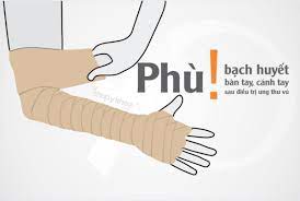 Vớ Tay Phù Bạch Huyết