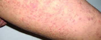 Image result for Vasculitis