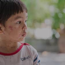 Common Childhood Exanthems