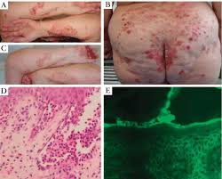 Image result for Pemphigus