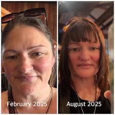 Noticeable face slimming after a month