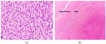 Endometrial polip teşhisi nasıl konur, nedir ve nasıl tedavi edilir? Diagnostics Free Full Text Update On Endometrial Stromal Tumours Of The Uterus Html