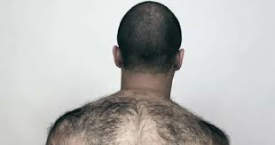 Image result for Hypertrichosis