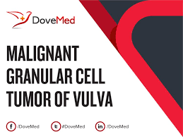 Malignant cells can also spread to other parts of the body . Malignant Granular Cell Tumor Of Vulva