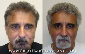 Permanent Hair Transplant Surgery Cost in South Carolina Horry Port  Harrelson
