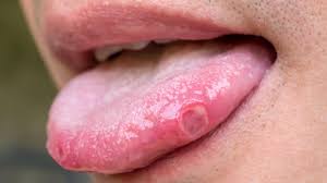 Blisters On The Tongue Pictures Causes And Treatments