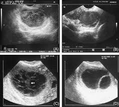 Image result for corpus luteum sonography)