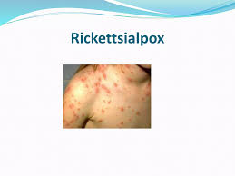Image result for Rickettsialpox