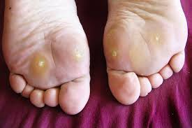 In these cases, the pads of the feet, the inside of the hind legs, and the bottom of the belly may start to turn yellow. Symptoms Causes And Treatment For Plantar Warts