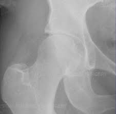 We did not find results for: Hip Arthritis Treatments Osteotomy Hip Replacement Hss