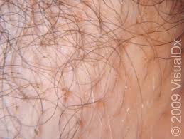 Image result for pubic lice symptoms