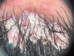 Image result for verrucae filiformes