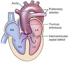 Truncus Arteriosus Communis Med Kom