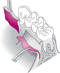 Vạt không di chuyển sau phẫu thuật (undisplaced flap)