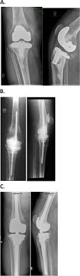 What are the possible later complications? Diagnosis And Management Of The Infected Total Knee Replacement A Practical Surgical Guide Journal Of Experimental Orthopaedics Full Text