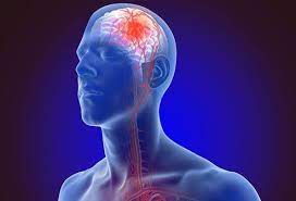 Symptoms are typically acute in onset and depend on the location of the stroke; Stroke Fast Symptoms Causes Types Treatment Prevention