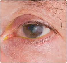 Maybe you would like to learn more about one of these? How Is Keratitis Diagnosed