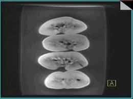 Image result for Nephrolithiasis Imaging